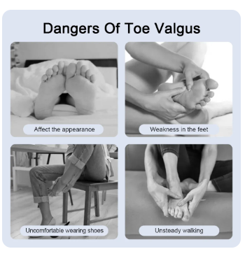 Adjustable Bunion Splint Corrector Big Toe Straightener Foot Hallux Valgus Braces Orthopedic Supplies Pedicure Correct Foot Bone 2 Adjustable Bunion Splint Corrector Big Toe Straightener Foot Hallux Valgus Braces Orthopedic Supplies Pedicure Correct Foot Bone - Image 2